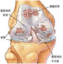 骨性关节炎
