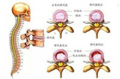 腰椎间盘突出症